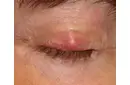 Bebeklerde Göz Kapağında Kızarıklık