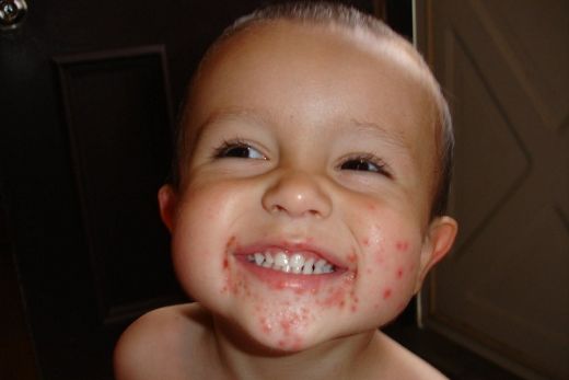 Bebeklerde Ağız Çevresinde Kızarıklık Nedenleri?