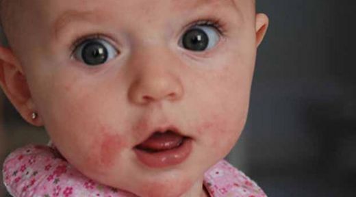 Bebeklerde Deride Kızarıklık Belirtileri ve Tedavisi