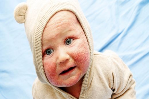 Bebeklerde Egzama Belirtileri ve Tedavisi