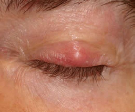 Bebeklerde Göz Kapağında Kızarıklık