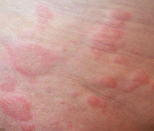 Bebeklerde Sırtta Kızarıklık Belirtileri ve Tedavisi