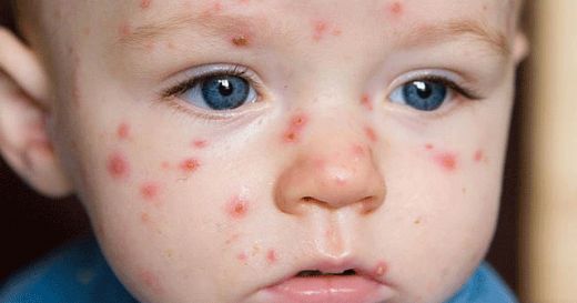 Bebeklerde Su Çiçeği Belirtileri ve Tedavisi