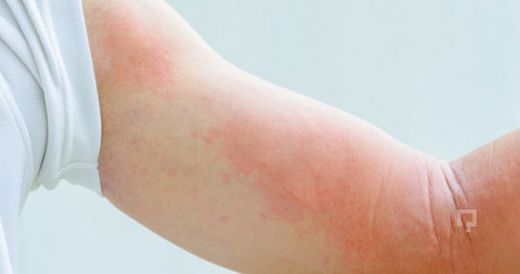 Bebeklerde Vücutta Kızarıklık Belirtileri ve Tedavisi