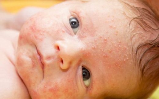Bebeklerde Yüzde Egzama Belirtileri ve Tedavisi